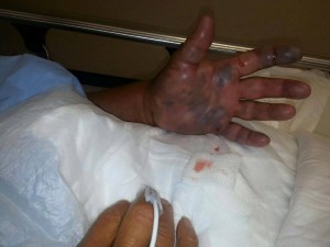 Vibrio Vulnificus, man dies from trigger fish cut, fish diseases that transfer to people,